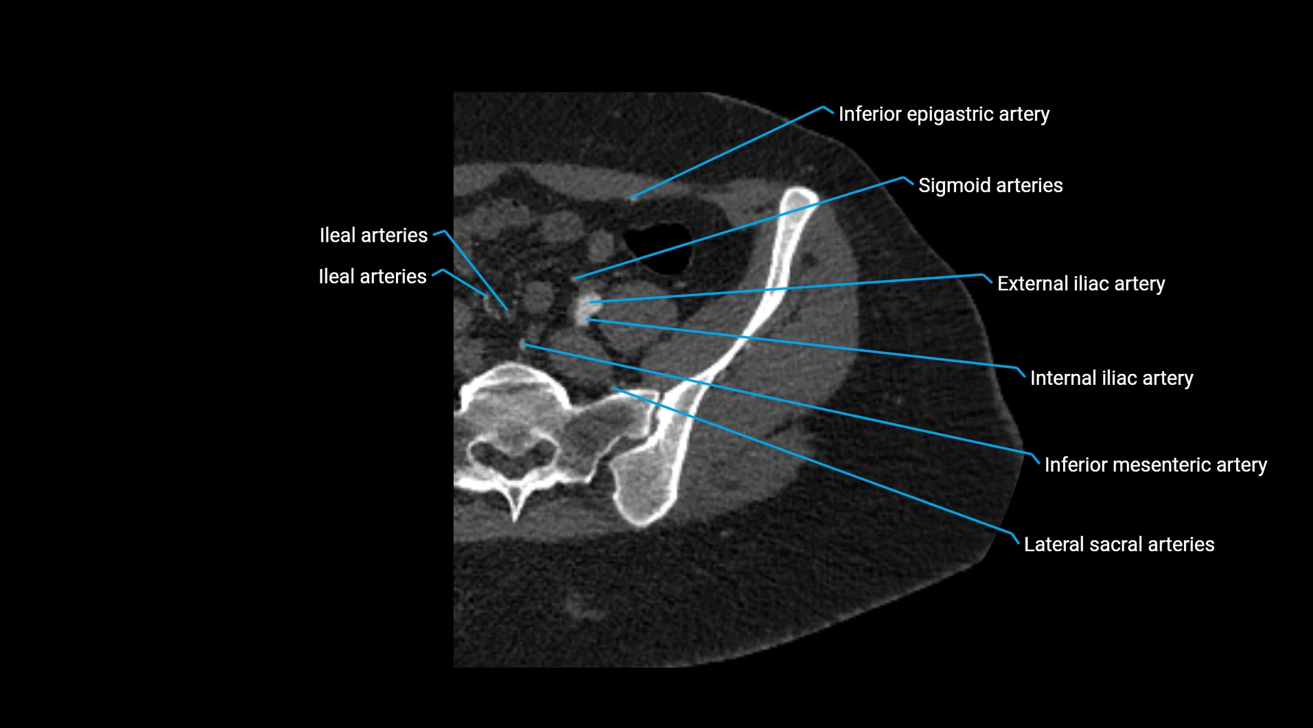 CTA lower limb cross sectional anatomy labelled image _21.webp